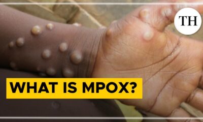 Watch: What is mpox? - The Hindu