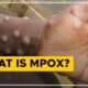 Watch: What is mpox? - The Hindu