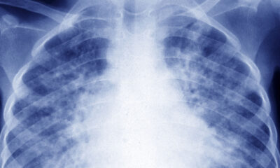 Clinical trial finds three new ways to treat drug-resistant tuberculosis