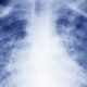 Clinical trial finds three new ways to treat drug-resistant tuberculosis