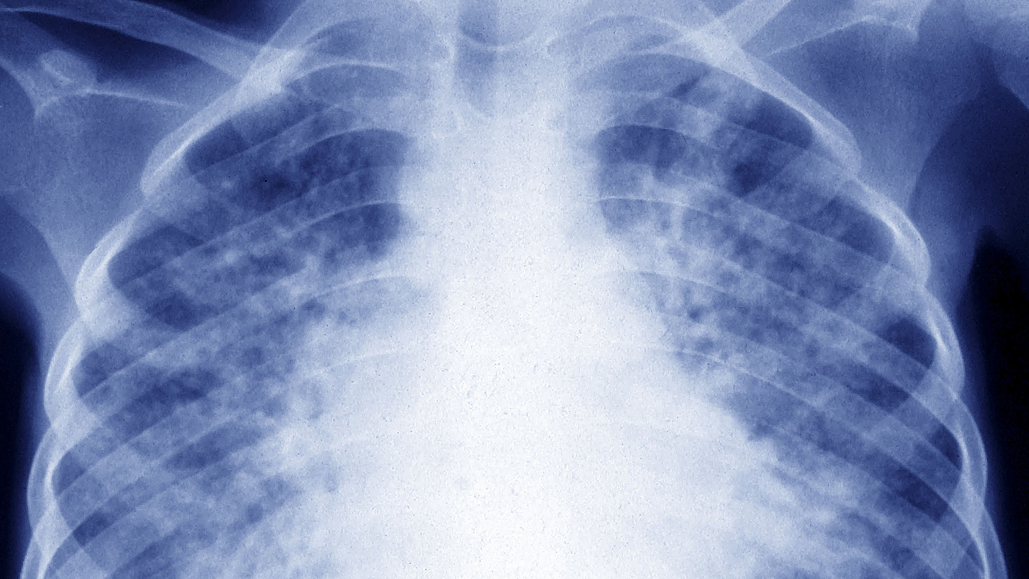 Clinical trial finds three new ways to treat drug-resistant tuberculosis