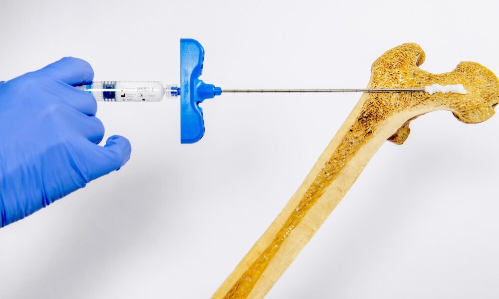 Injectable hydrogel can strengthen brittle bones