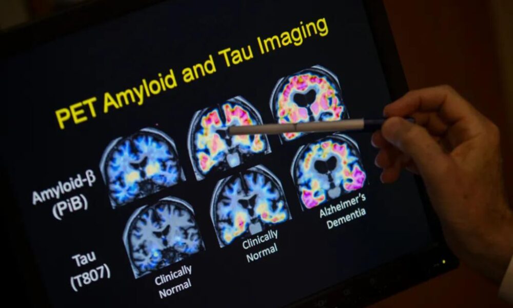 FDA approves blood test that can help diagnose Alzheimer's disease