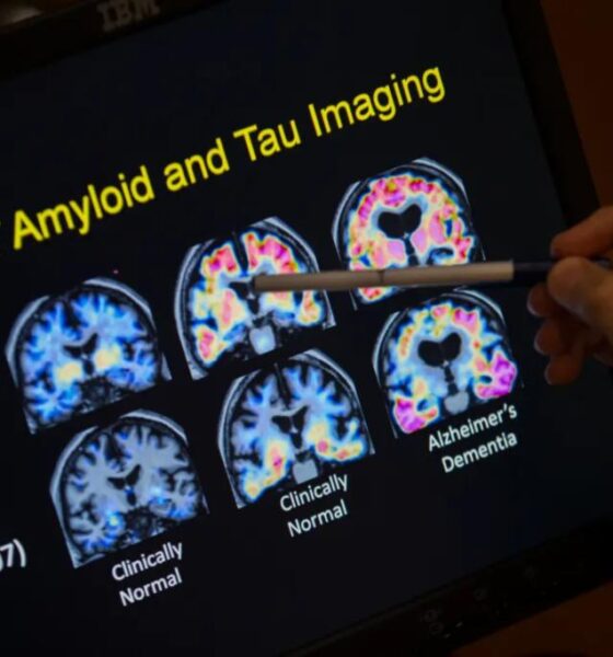 FDA approves blood test that can help diagnose Alzheimer's disease