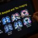 FDA approves blood test that can help diagnose Alzheimer's disease