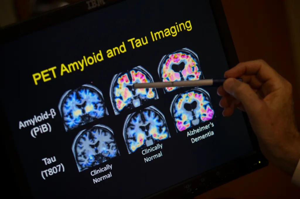 FDA approves blood test that can help diagnose Alzheimer's disease